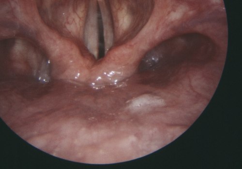 Why vocal cord paralysis?